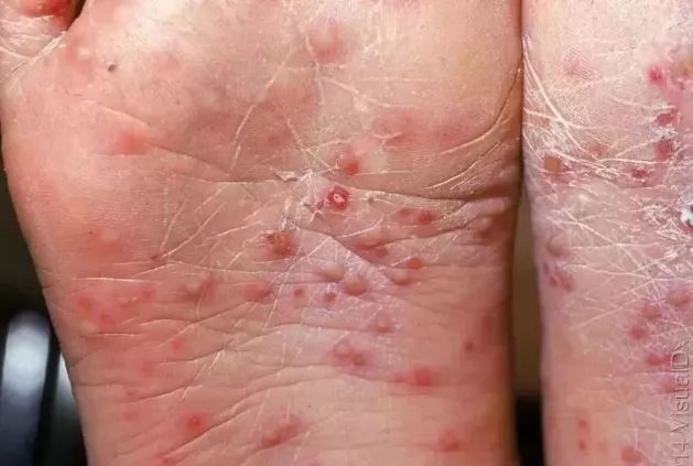 【感染性疾病前期有什么症状,感染性疾病前期有什么症状图片】 【感染性疾病前期有什么症状,感染性疾病前期有什么症状图片】